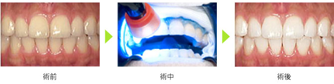 歯の漂白（ホワイトニング）治療｜ヤスダデンタルクリニック